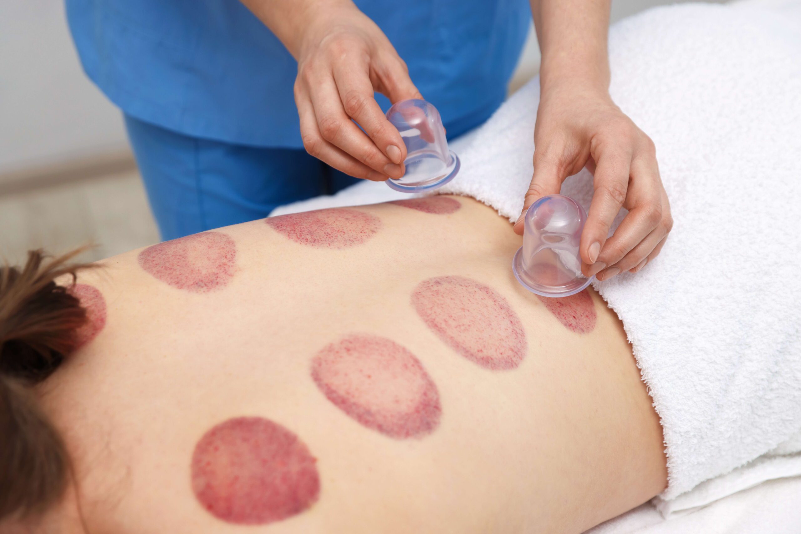 Cupping Therapy